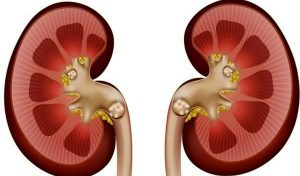 سنگ کلیه: علائم، علل و راهکارهای پیشگیری و درمان سنگ کلیه